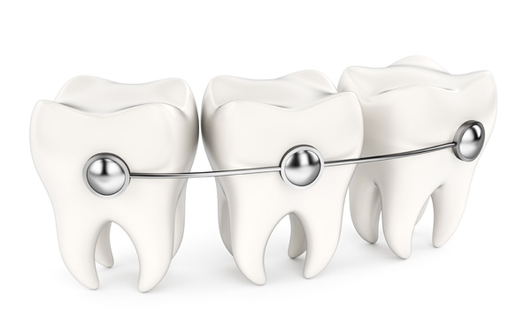 ortodoncia-autoligado-sonrisalud