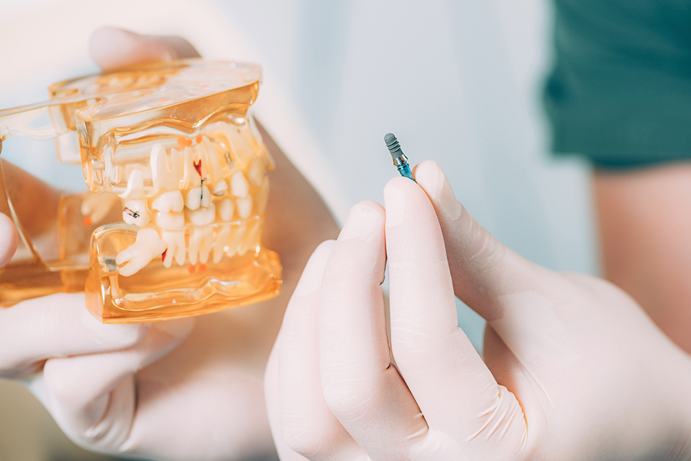 Implantes dentales en el mismo día