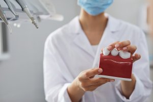 Cuidados Implantes Dentales